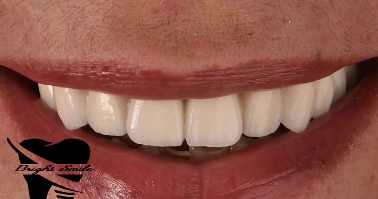 Nouveau sourire, nouvelle vie - Transformation 6